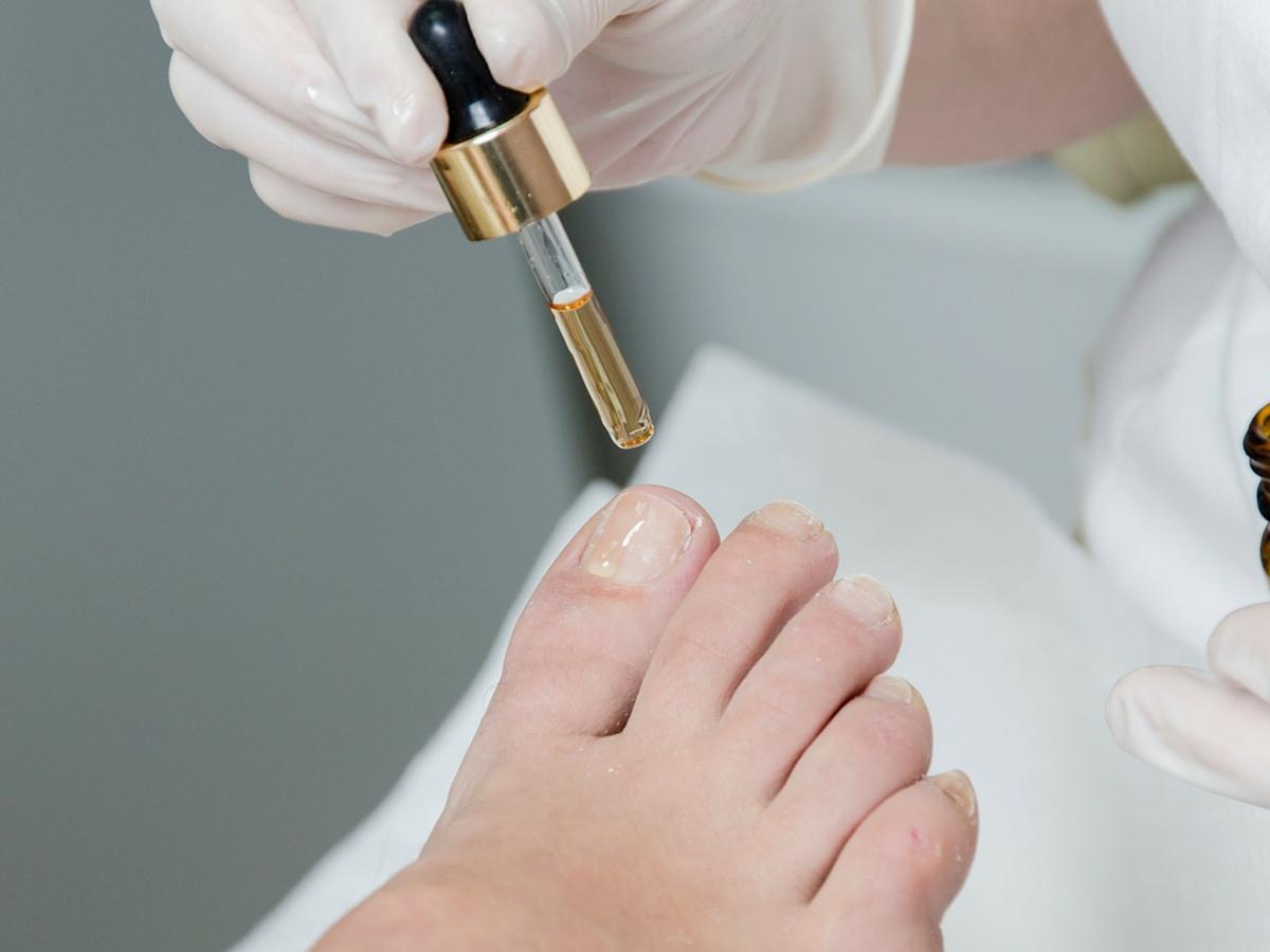 Micosi alle unghie di piedi e mani: come curarle - Prodotti e Offerte